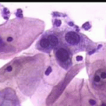 Παραβασικά κύτταρα με διογκωμένους ομοιογενείς, χωρίς ορατή δομή χρωματίνης πυρήνες. Επίχρισμα του 2004 